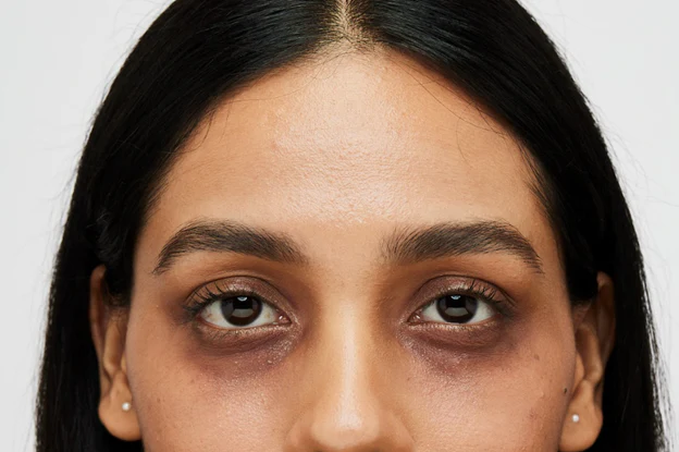 dark circles