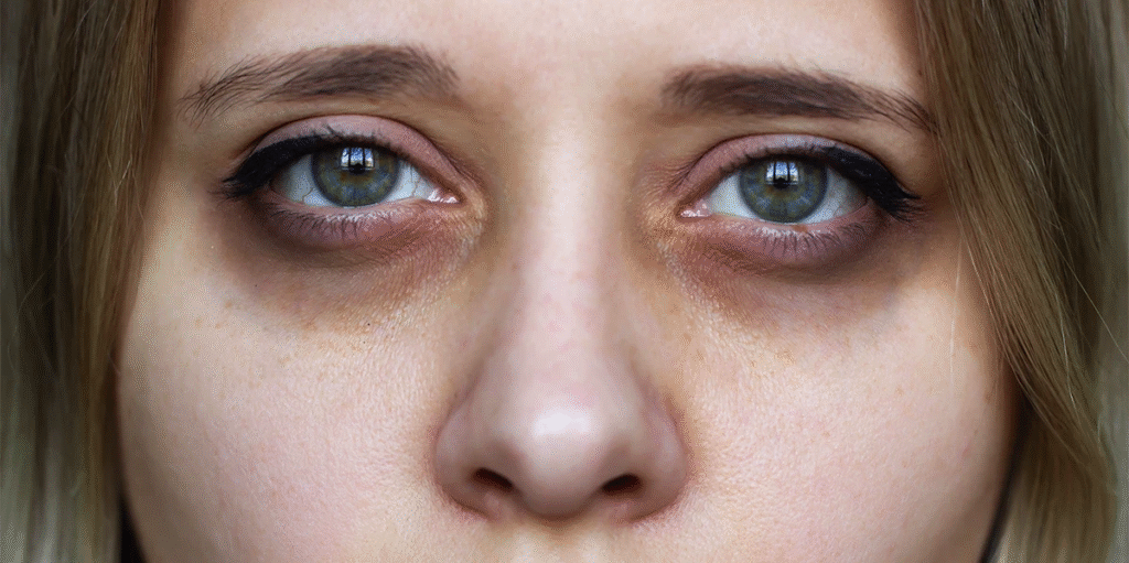 dark circles